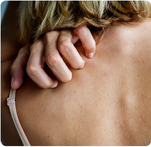 las causas de la dermatitis atópica no se conocen con exactitud