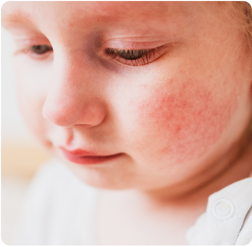 la cara es una de las zonas del cuerpo afectadas por la dermatitis atópica en menores de dos años